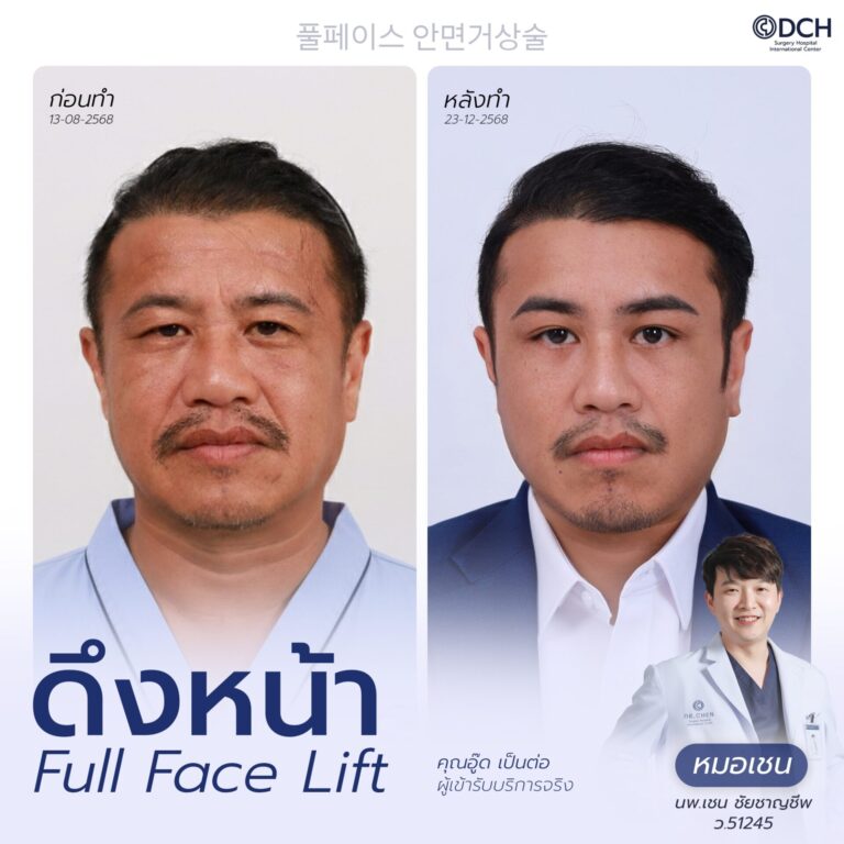 ดึงหน้า