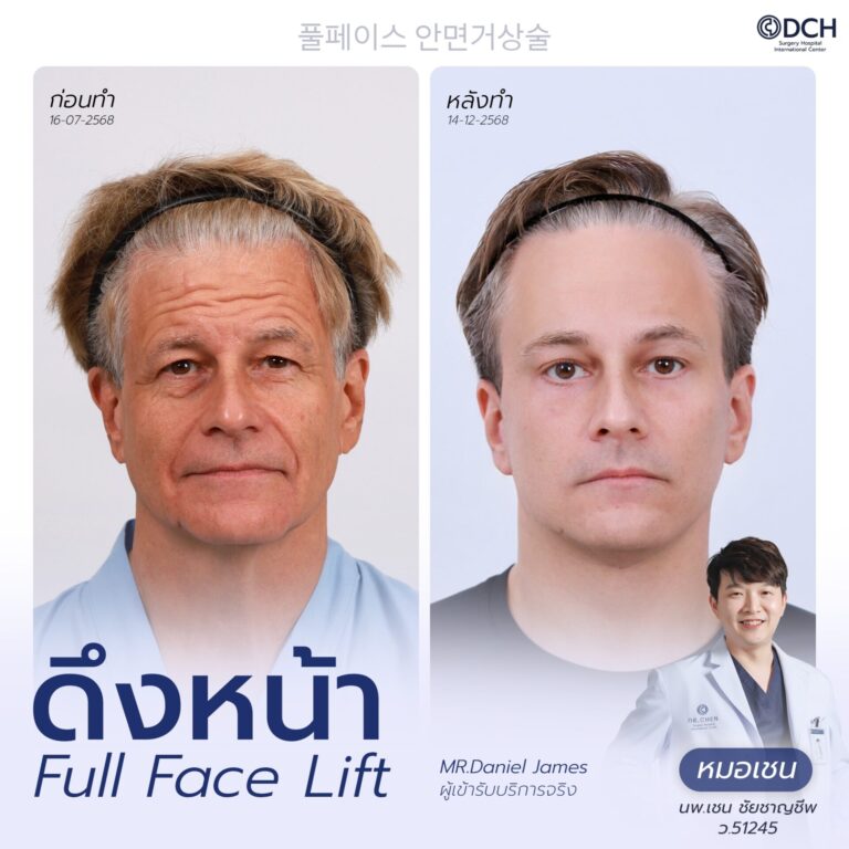 ดึงหน้า