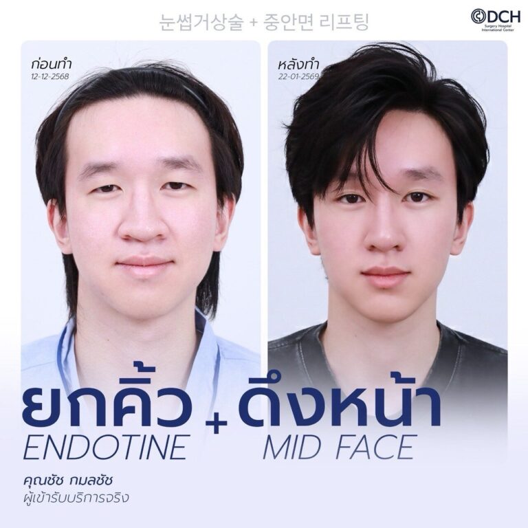 ยกคิ้ว EBL