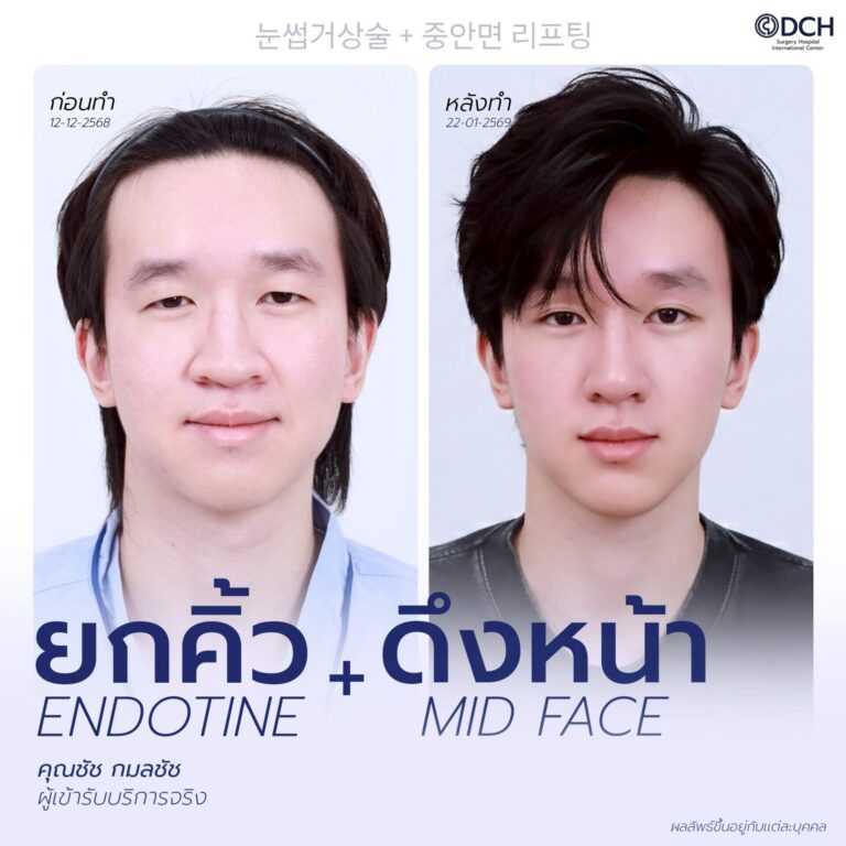 ยกคิ้ว EBL