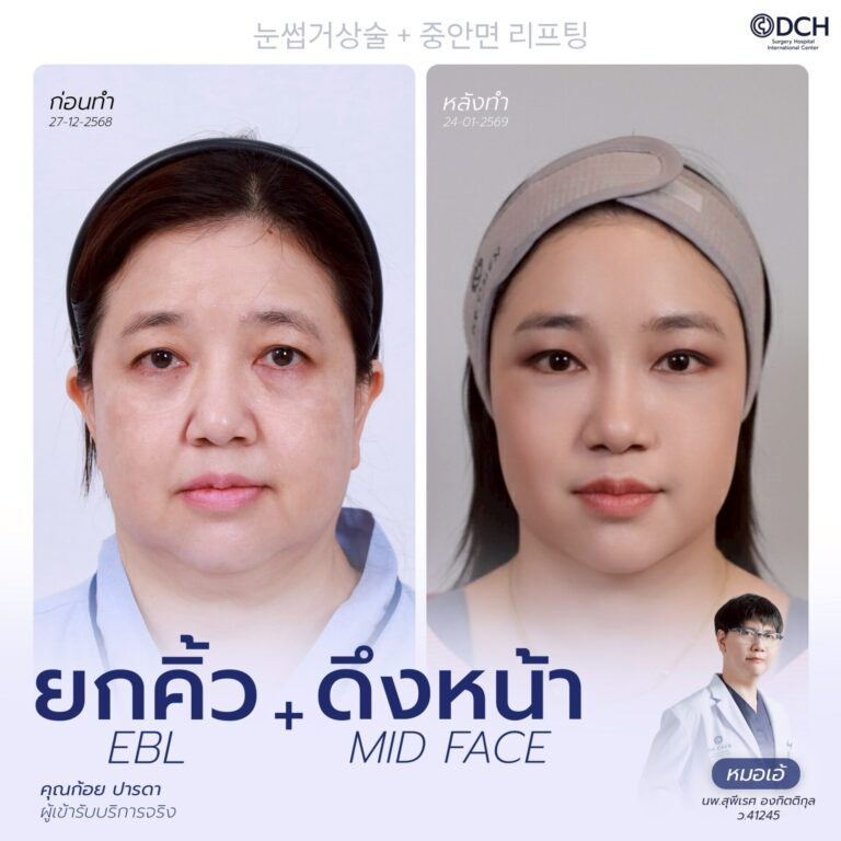 ยกคิ้ว EBL