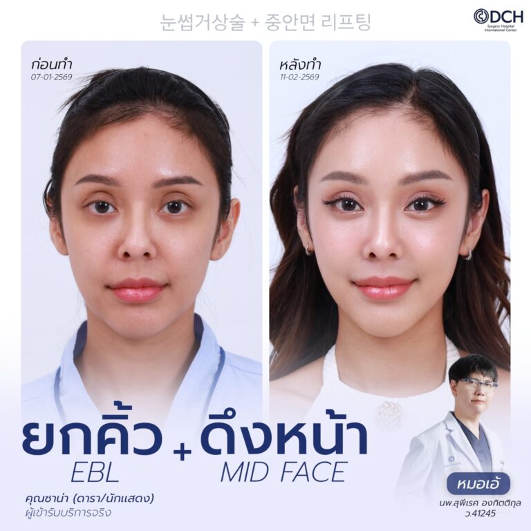 ยกคิ้ว EBL