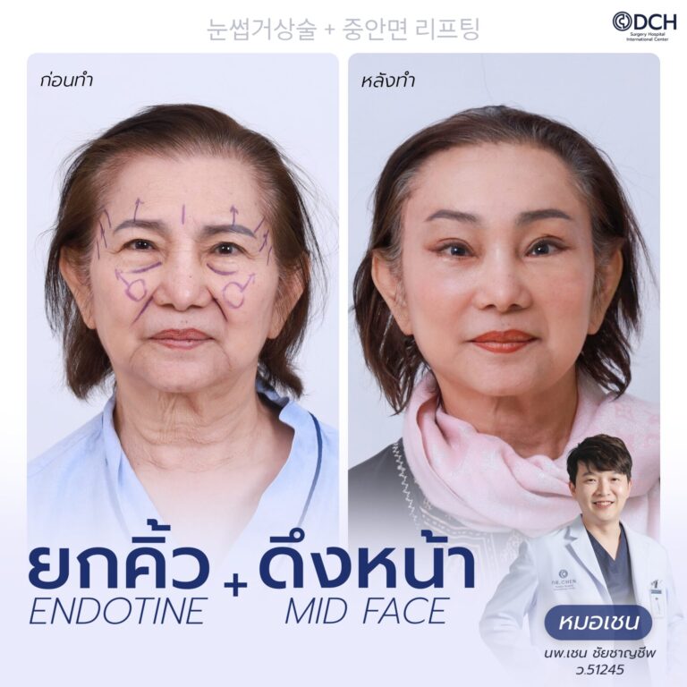 ยกคิ้ว EBL