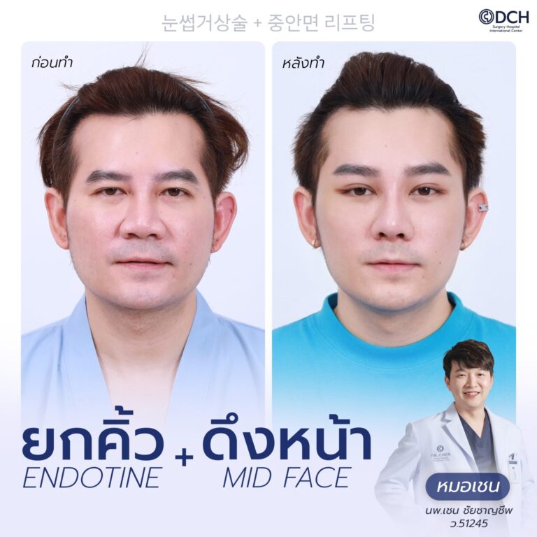 ยกคิ้ว EBL