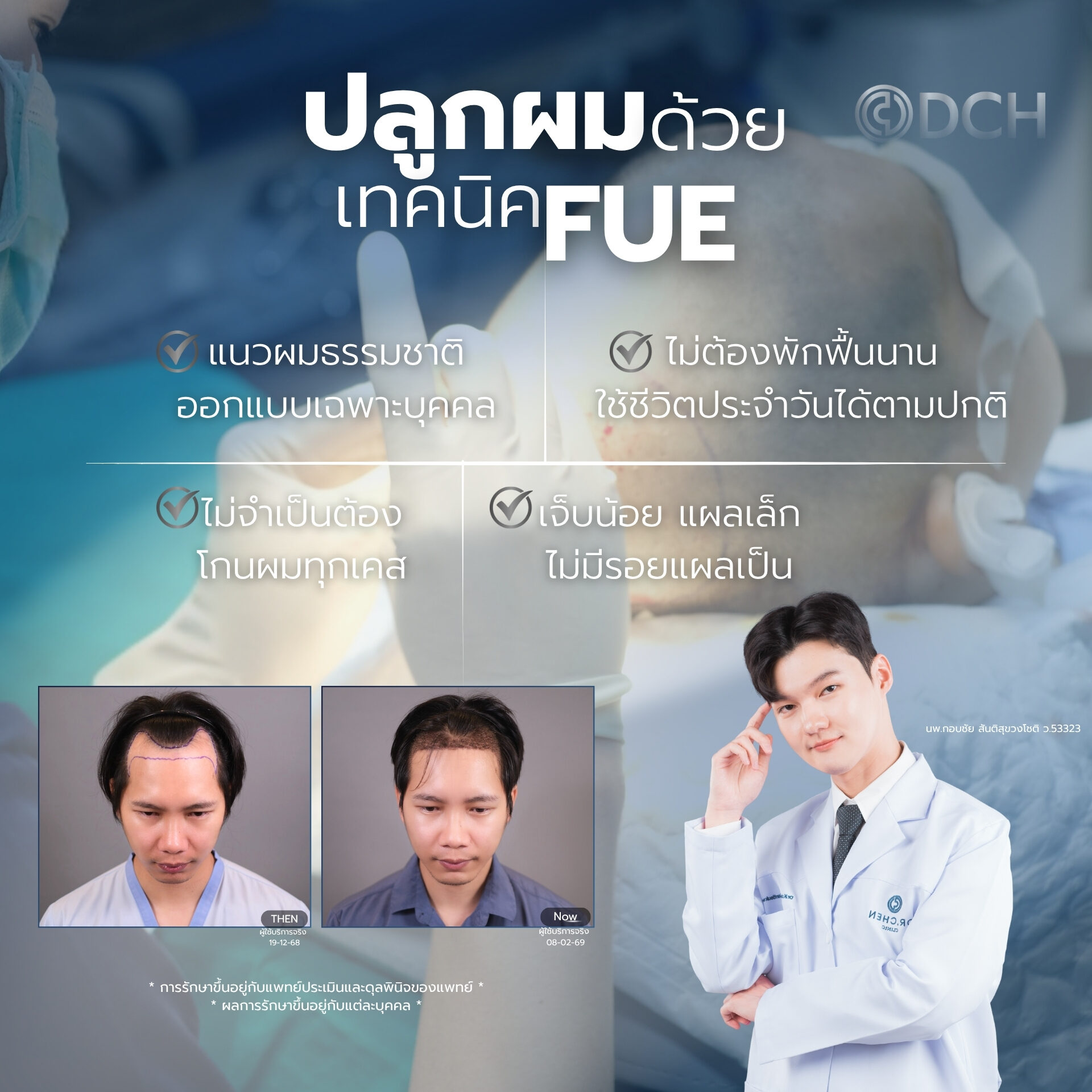 ปลูกผม หมอแบงค์ ด้วยเทคนิค DHI ความละเอียดสูง ที่ DCH