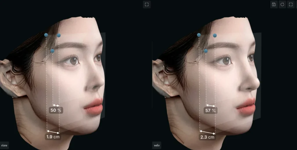 3D เสริมจมูก