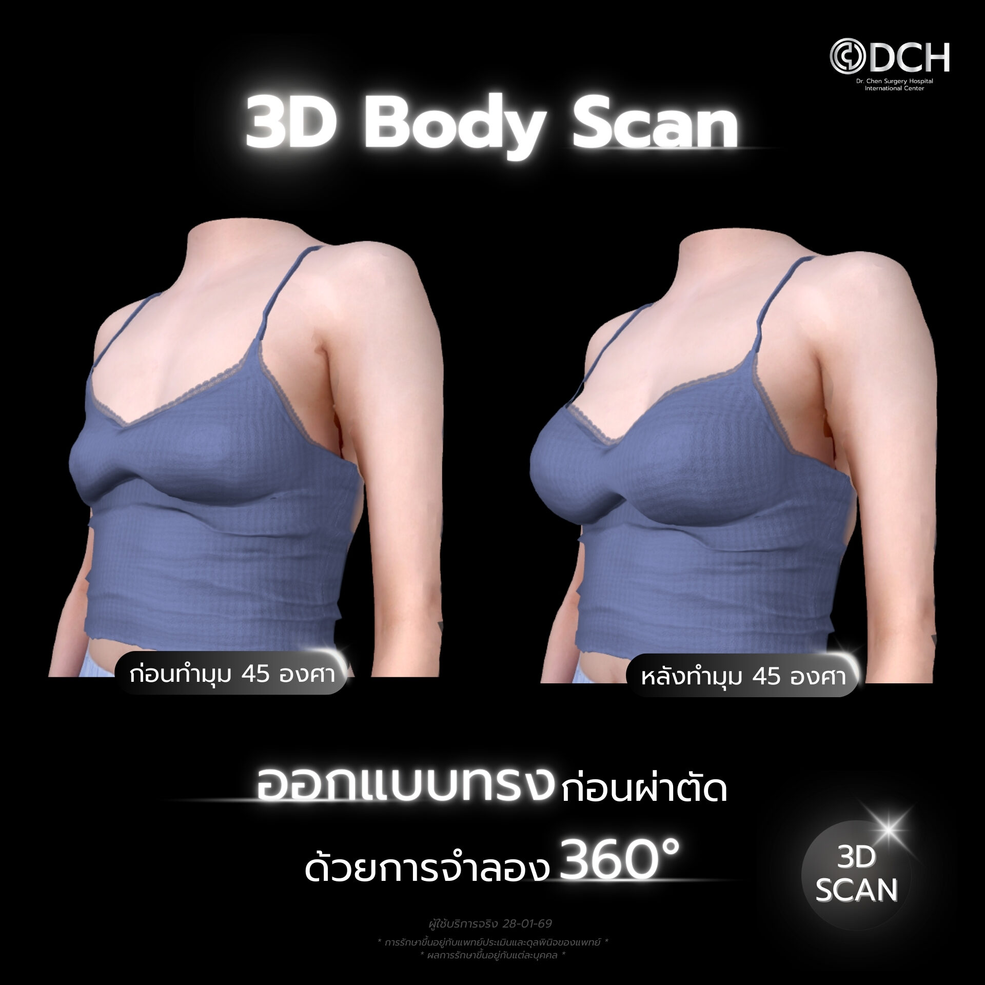 ทำหน้าอก Mentor 4DX หมอเชน รีวิวทรงอกธรรมชาติ DCH Korea 4DX