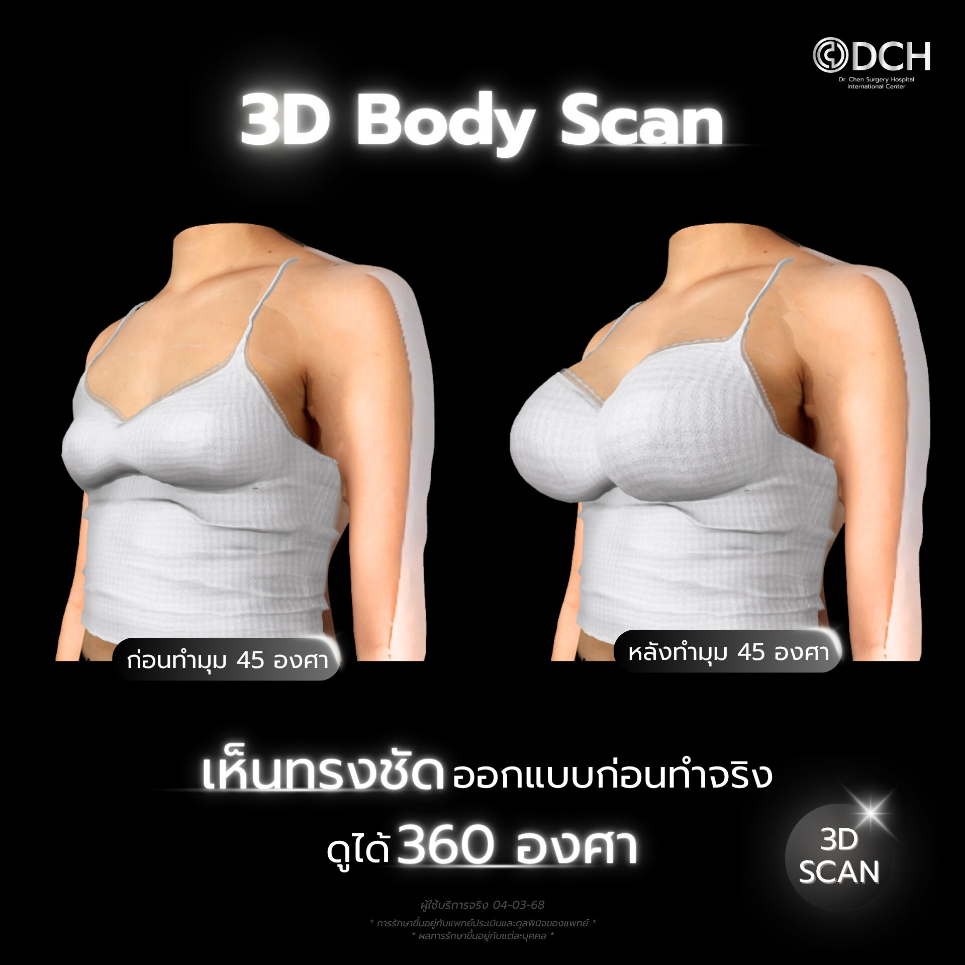 3D Body Scan เสริมหน้าอกMentor ที่ DCH Hospital จำลองผลลัพธ์ก่อนทำ