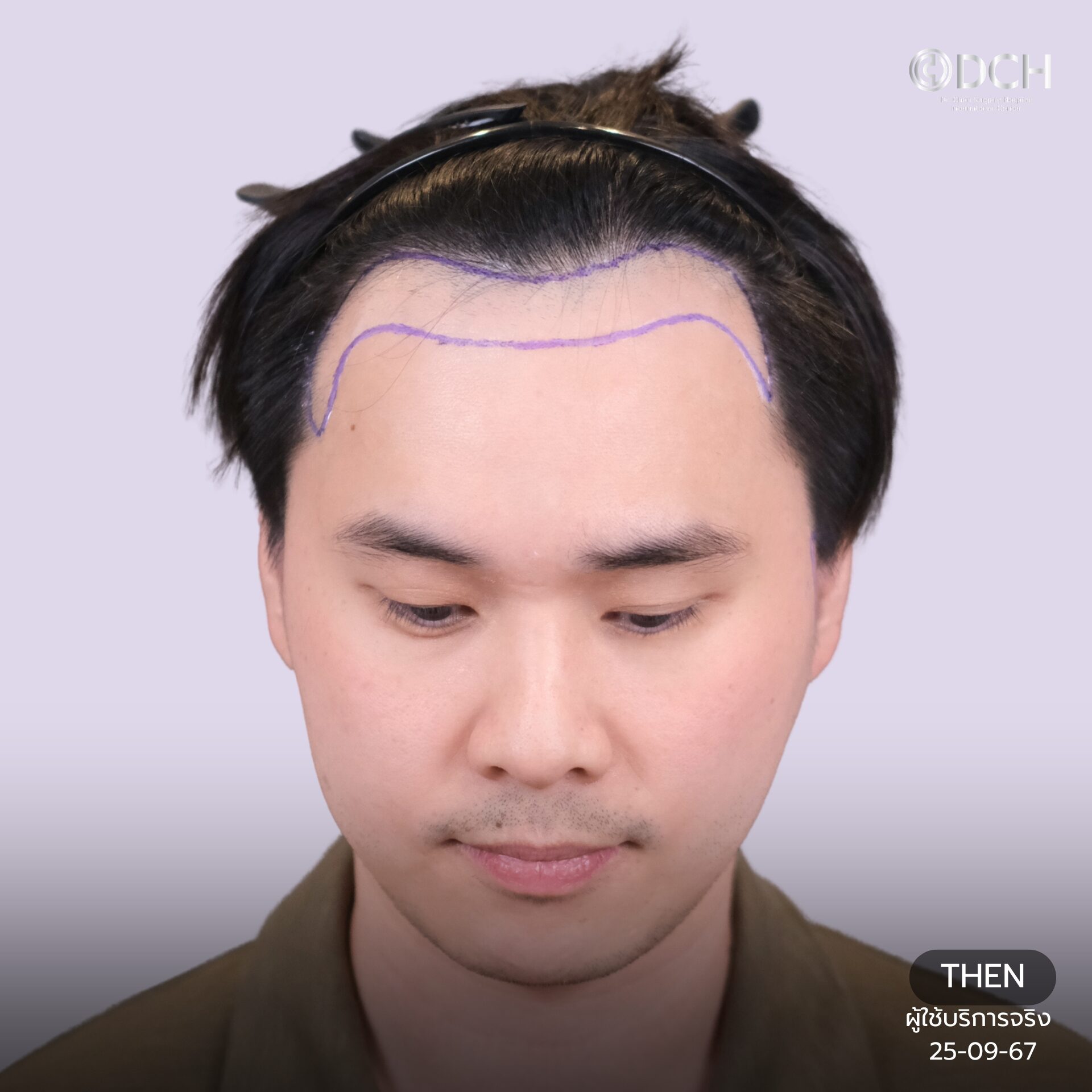 hair transplant 8 months result khun boss hairline before design dr bank