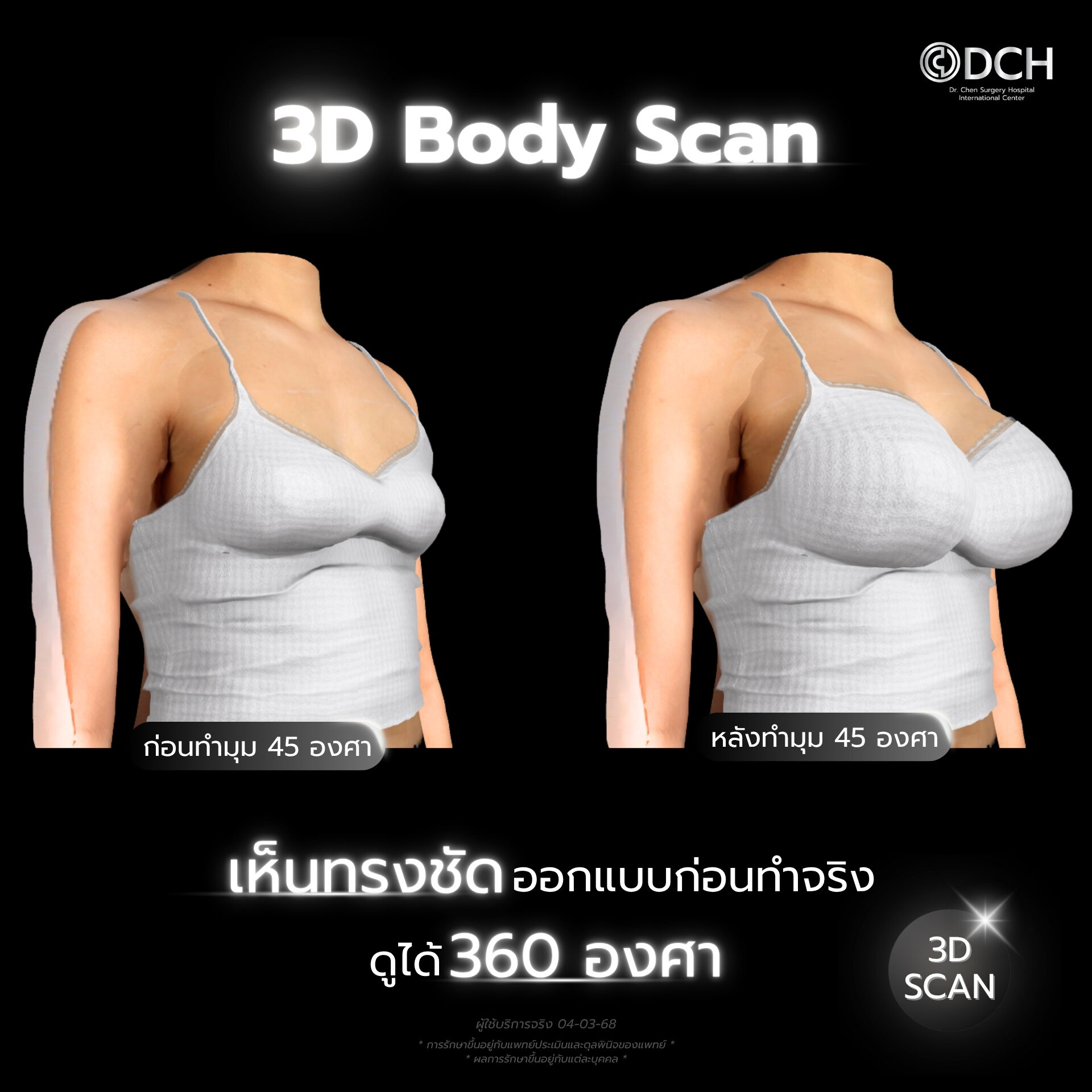 3D Body Scan เสริมหน้าอกMentor ที่ DCH Hospital จำลองผลลัพธ์ก่อนทำ