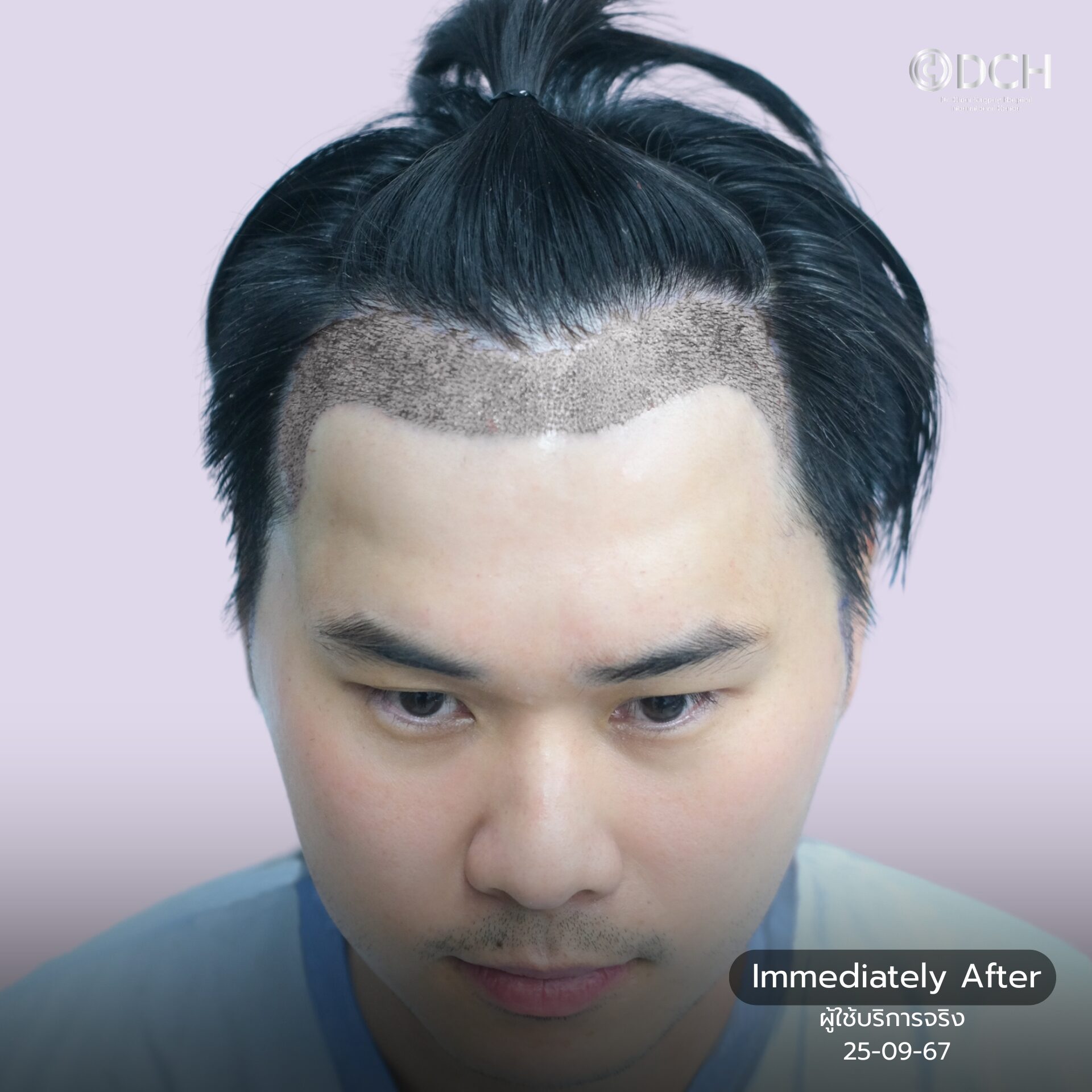 hair transplant 8 months result khun boss hairline before design dr bank