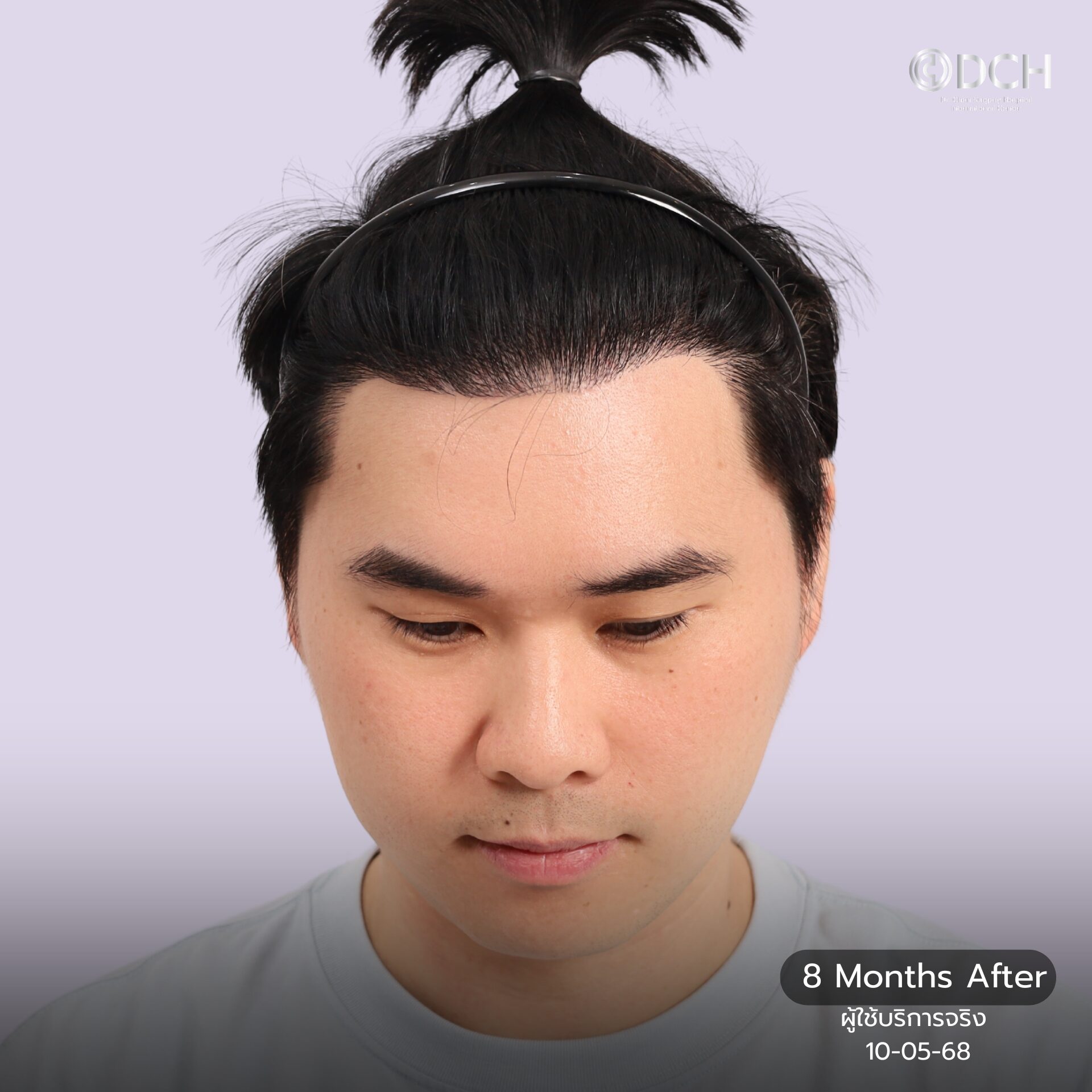 hair transplant 8 months result khun boss hairline before design dr bank