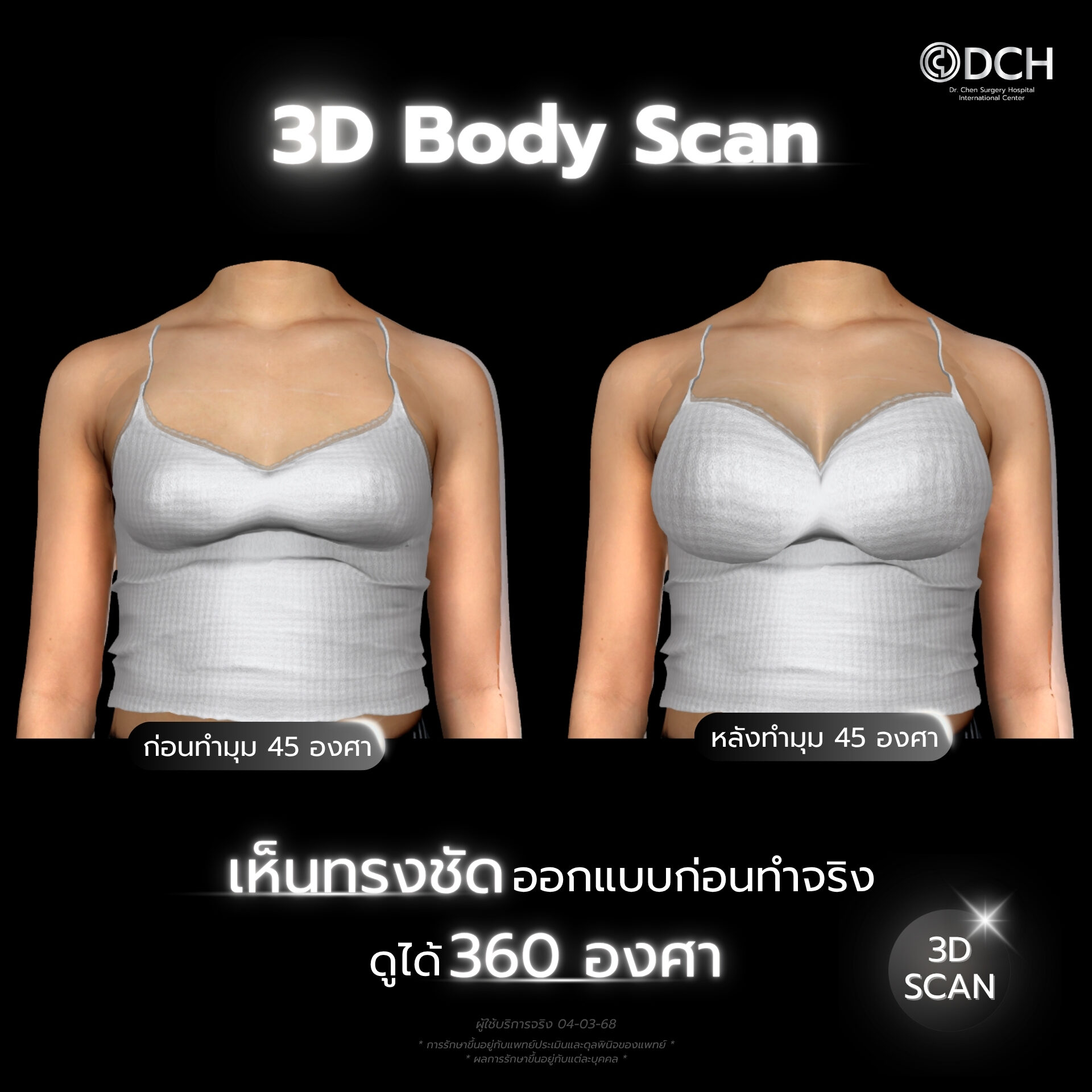 3D Body Scan เสริมหน้าอกMentor ที่ DCH Hospital จำลองผลลัพธ์ก่อนทำ