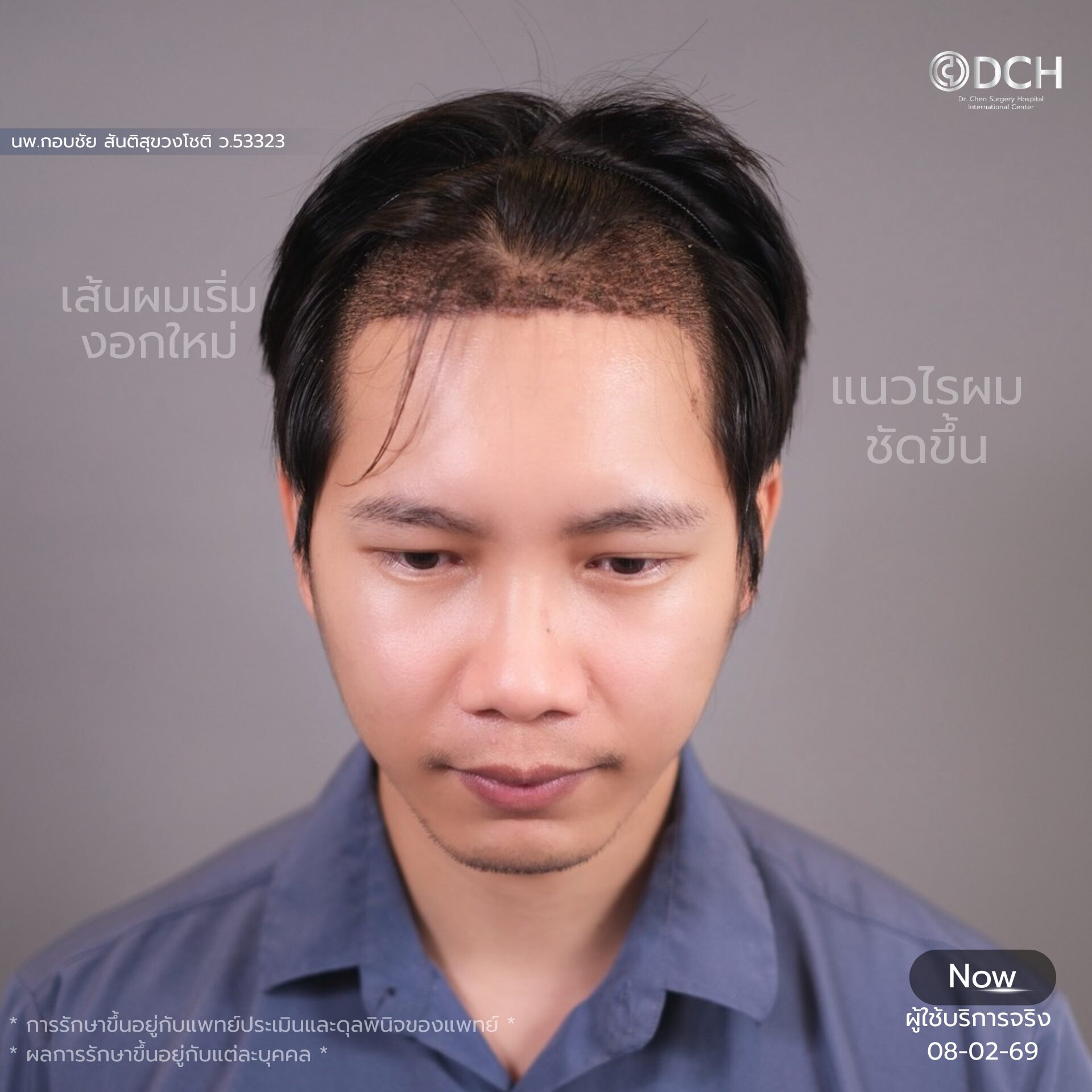 ปลูกผม แก้ผมบางกรรมพันธุ์ ก่อนทำ