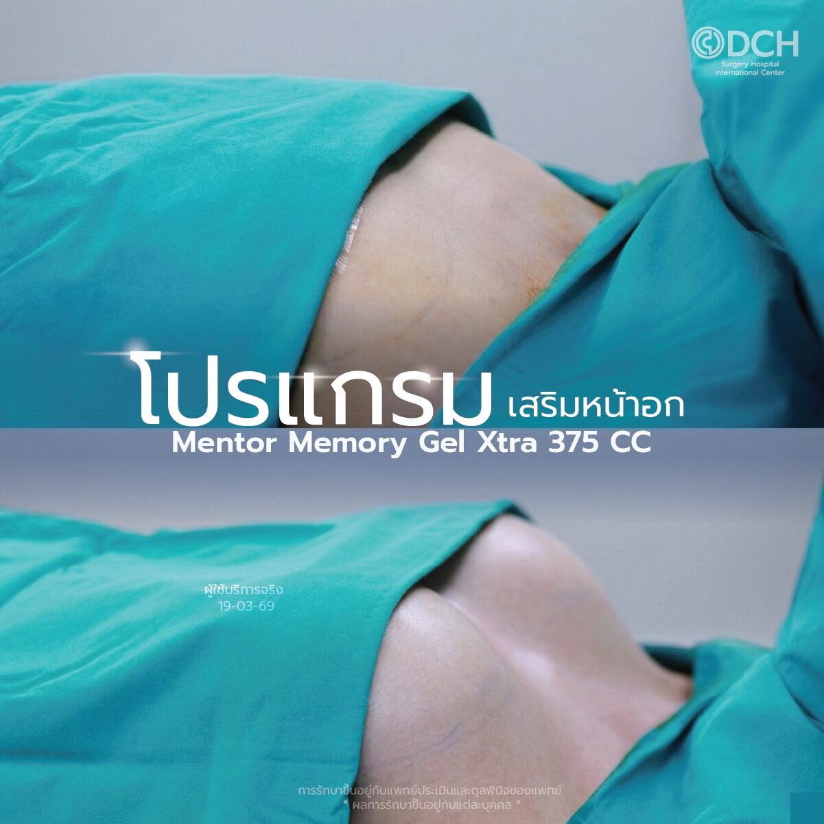 รีวิวผลลัพธ์ เสริมหน้าอก ทรงสวยธรรมชาติ เคสคุณแซ็ก DCH Hospital