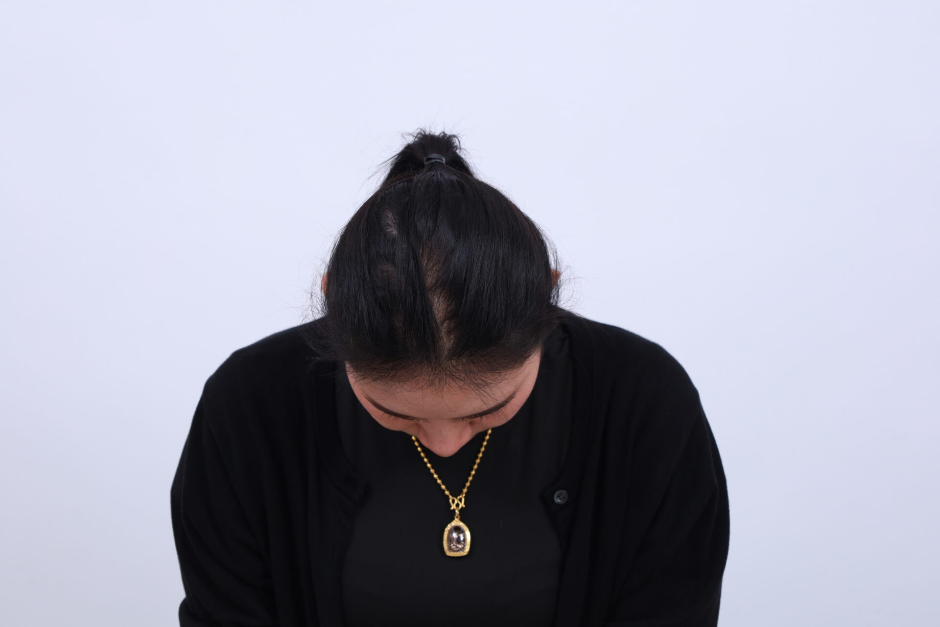 ปลูกผม แก้ผมบางกรรมพันธุ์ ก่อนทำ