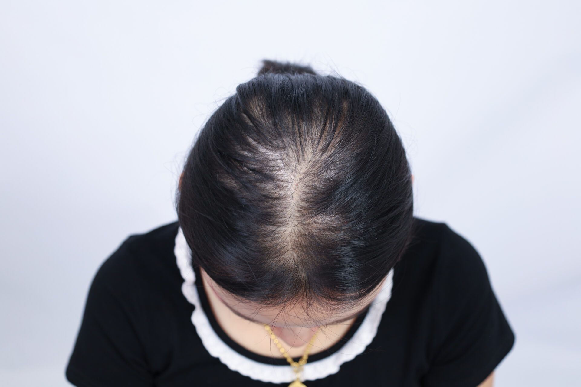 ปลูกผม แก้ผมบางกรรมพันธุ์ ก่อนทำ