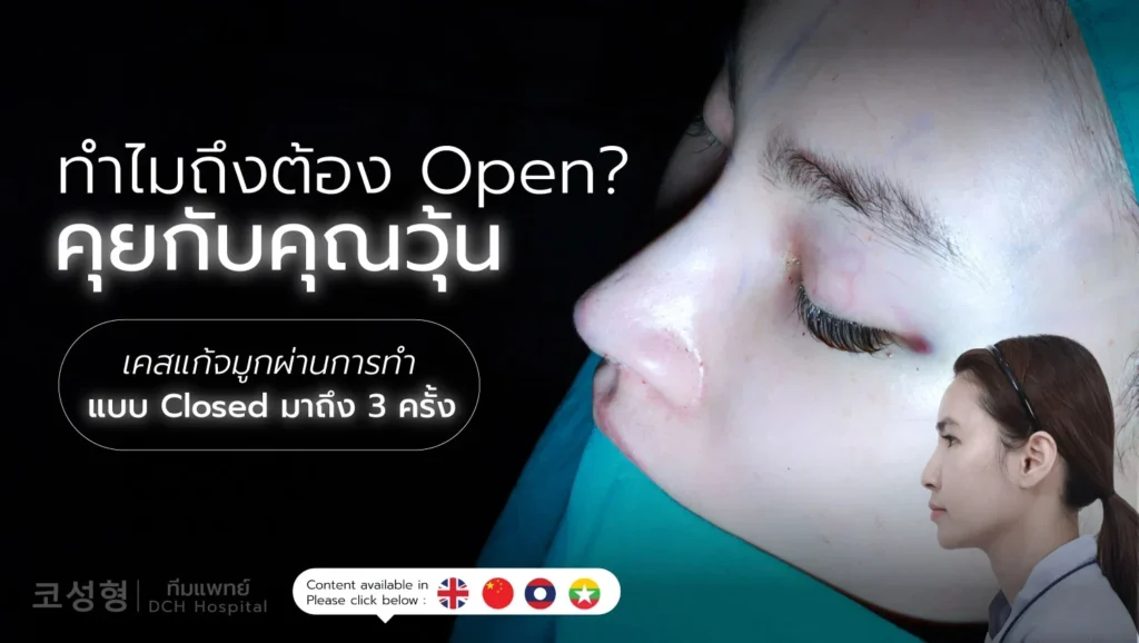 แก้จมูกวุ้น