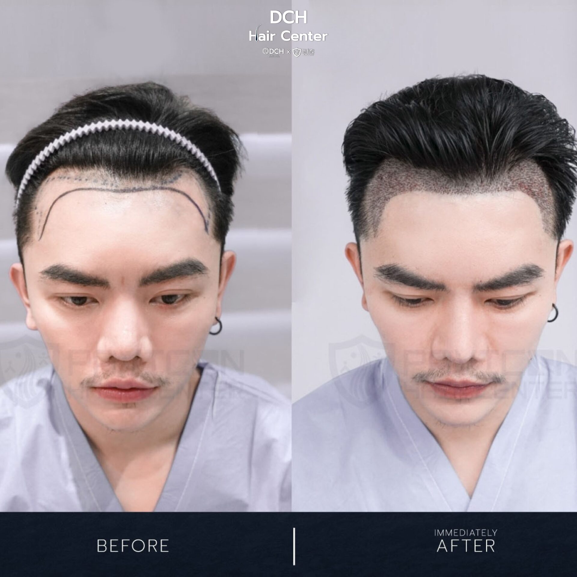 ผลลัพธ์ปลูกผมถาวร ก่อนและหลัง ทำให้ผมแน่นขึ้นอย่างเป็นธรรมชาติ