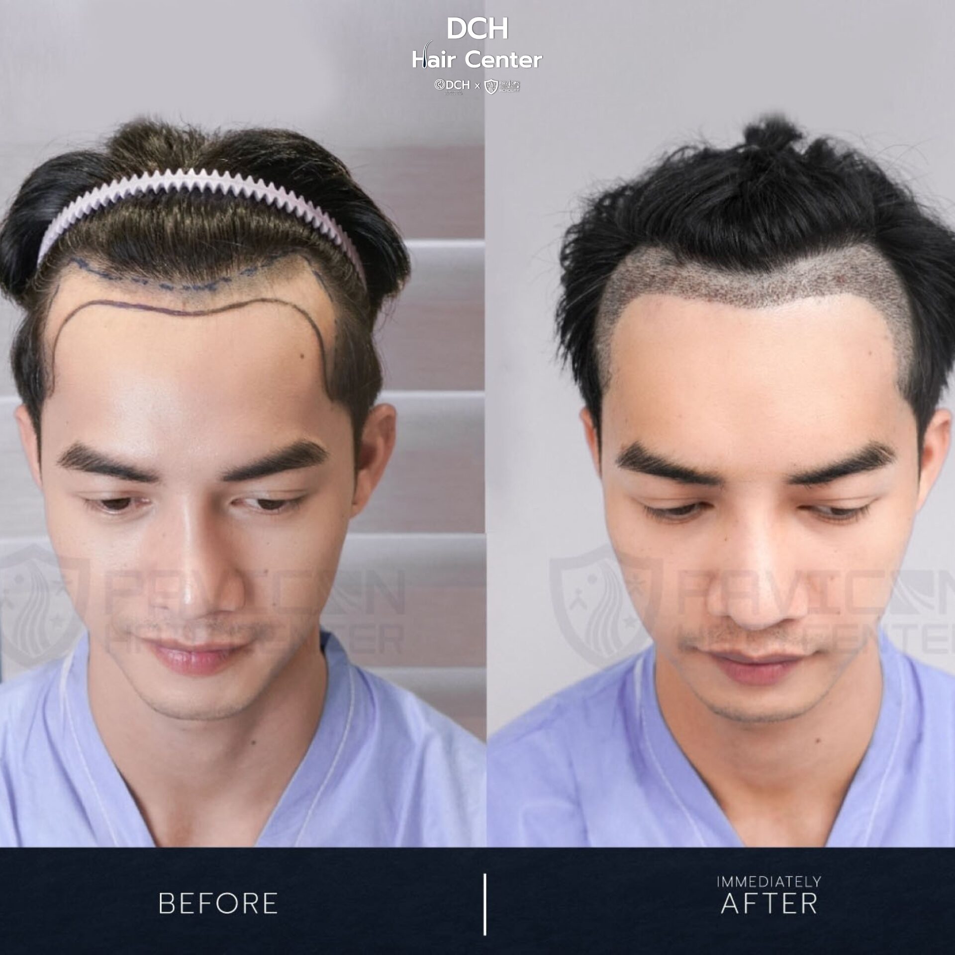 ผลลัพธ์ปลูกผมถาวร ก่อนและหลัง ทำให้ผมแน่นขึ้นอย่างเป็นธรรมชาติ