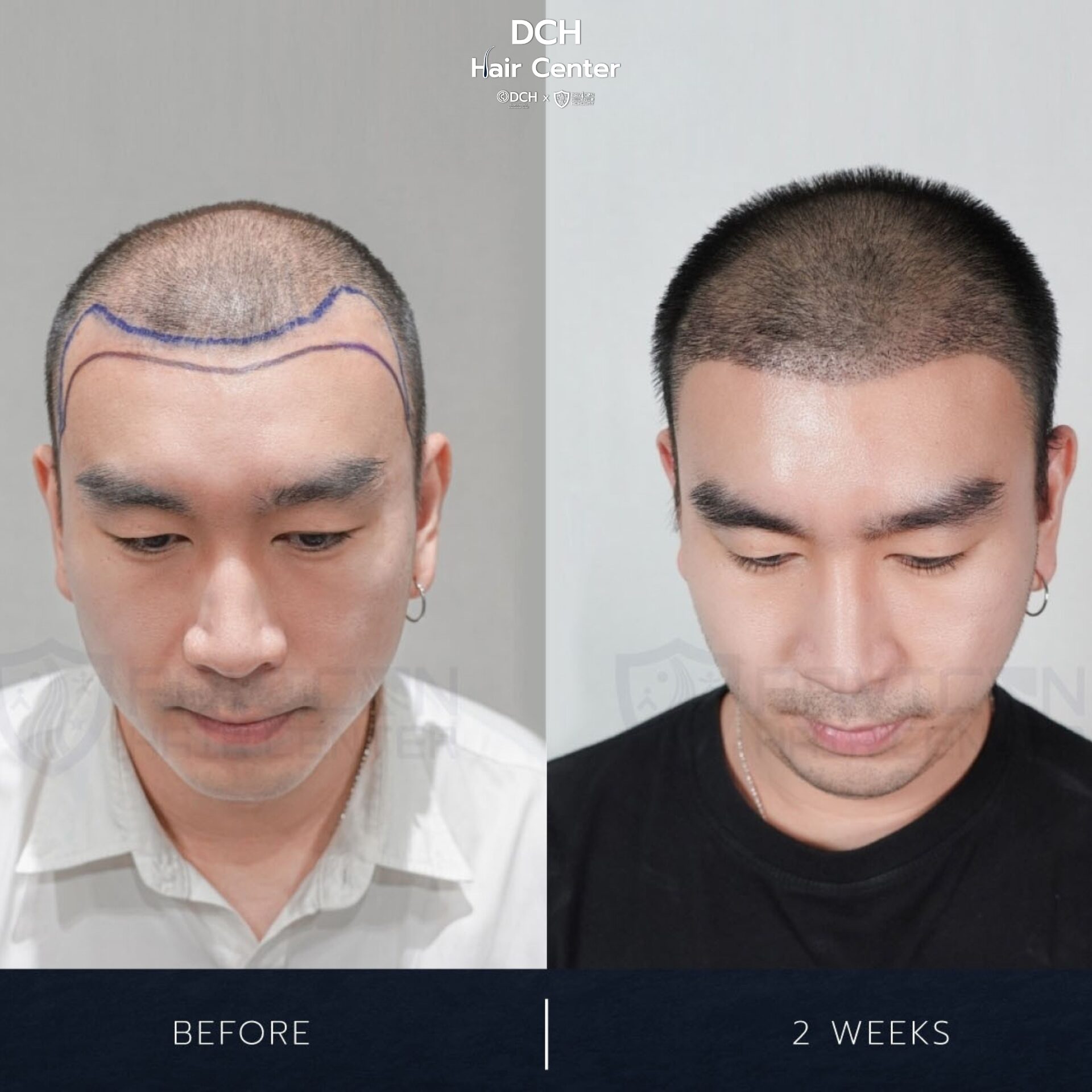 ผลลัพธ์ปลูกผมถาวร ก่อนและหลัง ทำให้ผมแน่นขึ้นอย่างเป็นธรรมชาติ