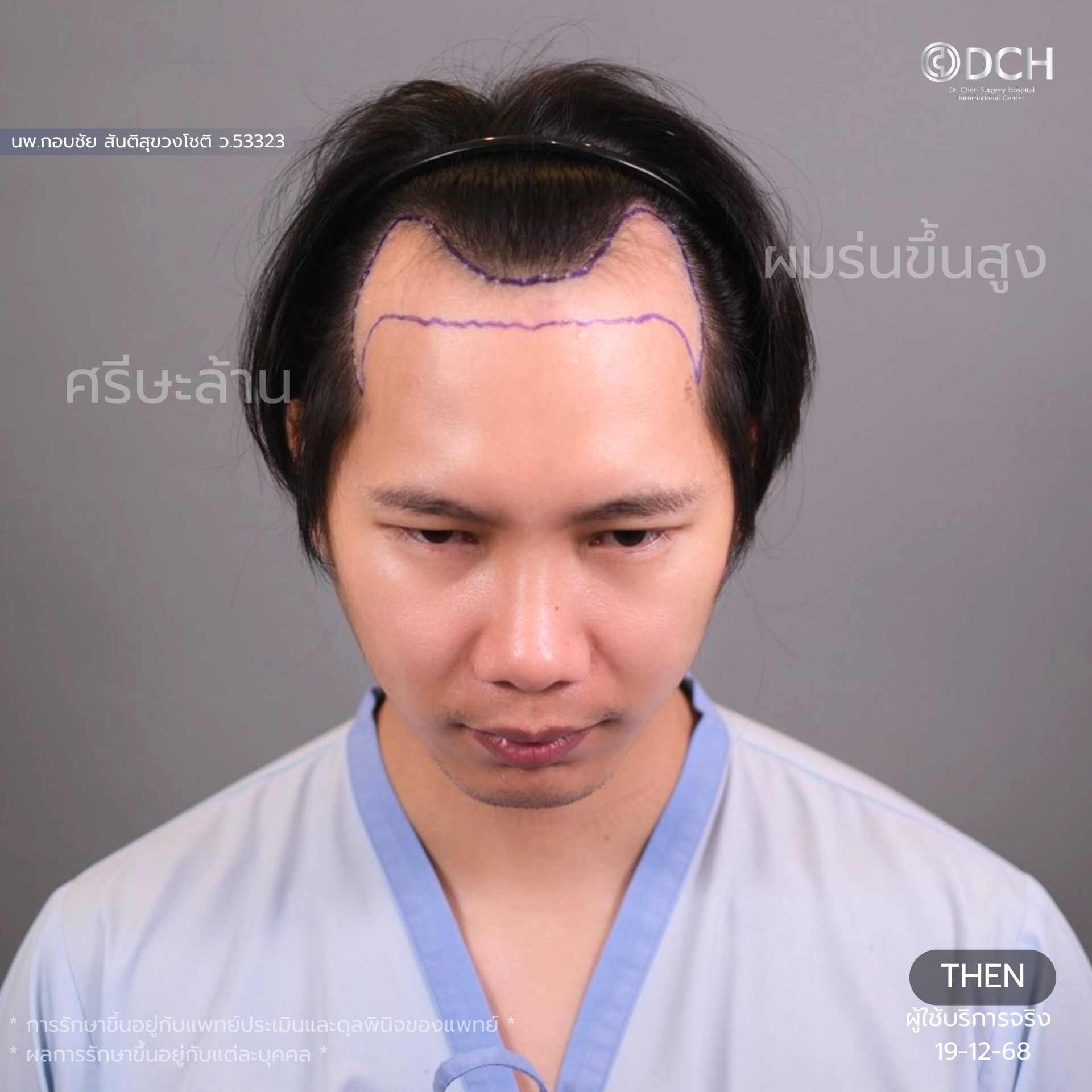 ปลูกผม แก้ผมบางกรรมพันธุ์ ก่อนทำ