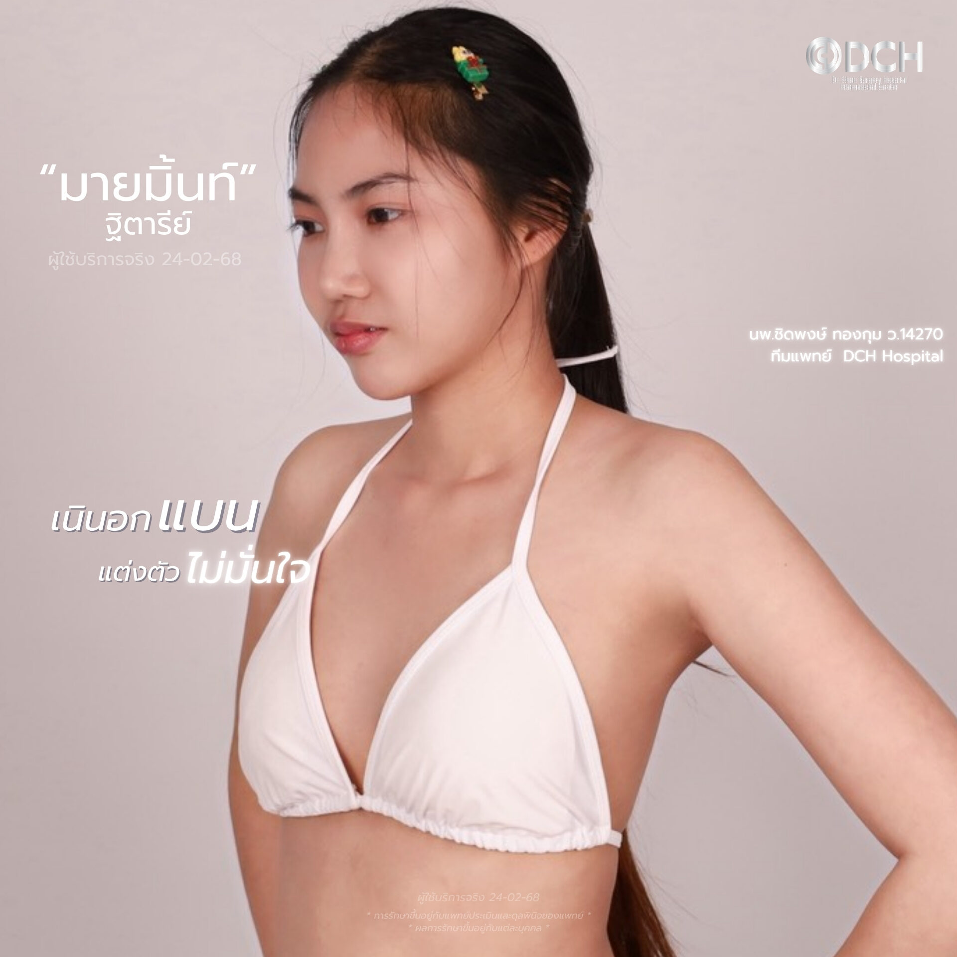 เสริมหน้าอกMentor ที่ DCH Hospital รีวิวพนักงาน ผลลัพธ์ดูเป็นธรรมชาติ