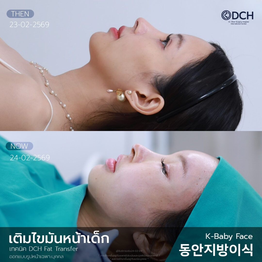 เติมไขมันหน้าเด็ก ขั้นตอนประเมินและออกแบบรูปหน้าโดยแพทย์