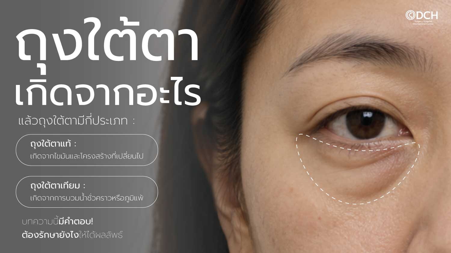 ถุงใต้ตา