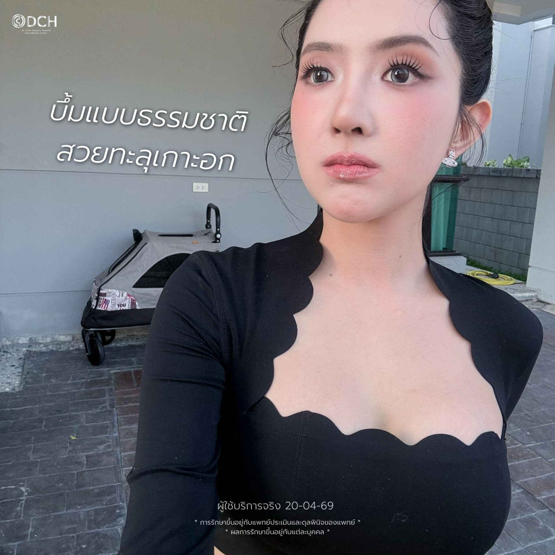 เบียร์ The Voice รีวิวเสริมหน้าอก 11 วัน ด้วย Motiva Ergonomix 380cc ที่ DCH Hospital