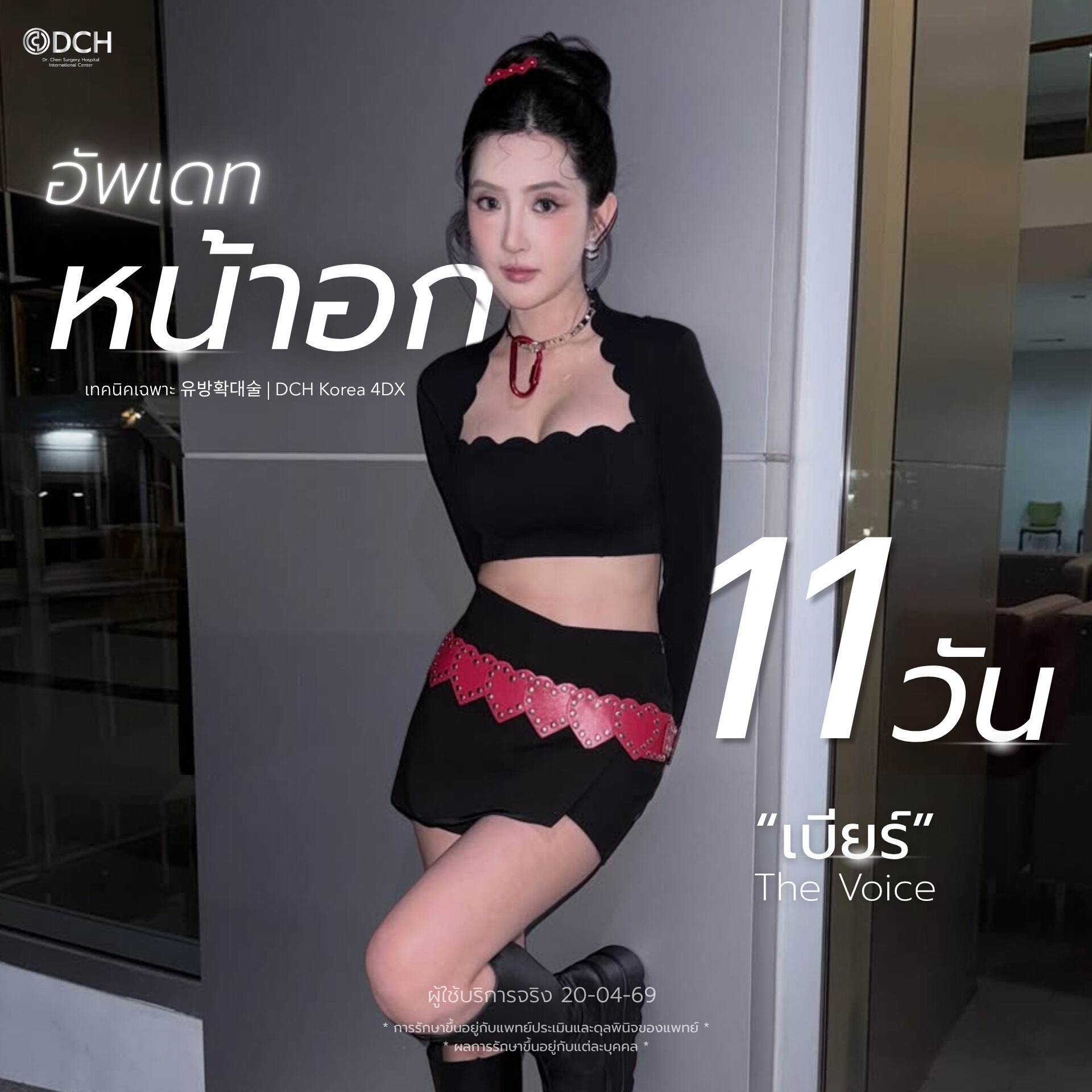 เบียร์ The Voice รีวิวเสริมหน้าอก 11 วัน ด้วย Motiva Ergonomix 380cc ที่ DCH Hospital