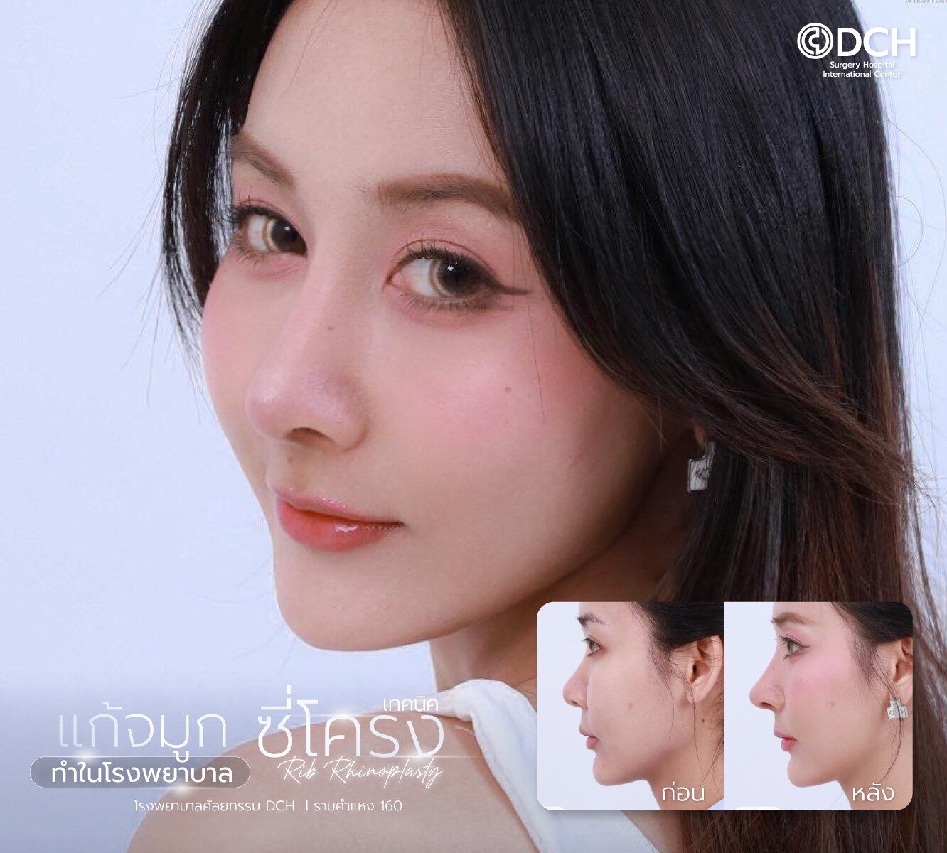 แก้จมูกซี่โครง
