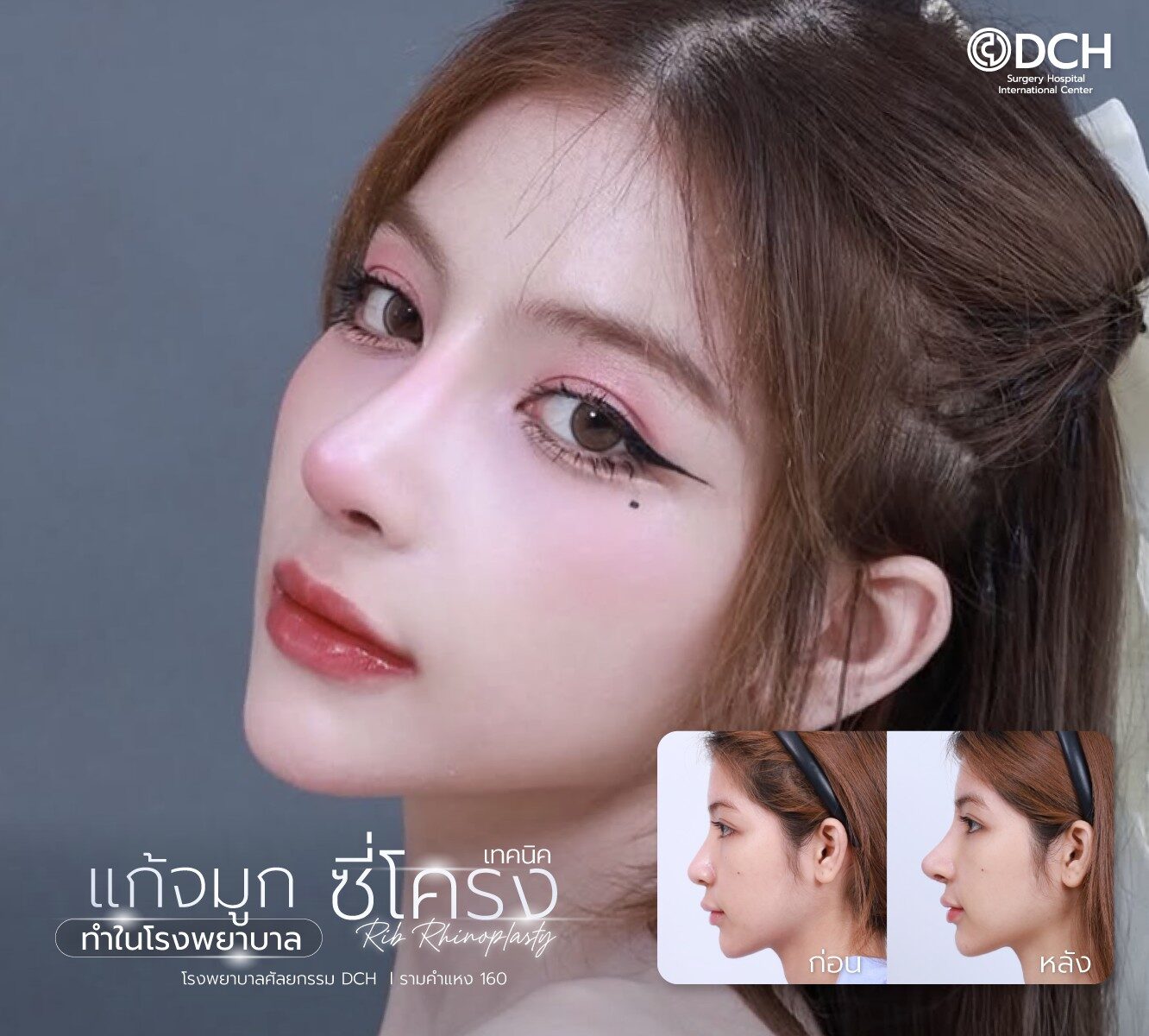 แก้จมูกซี่โครง