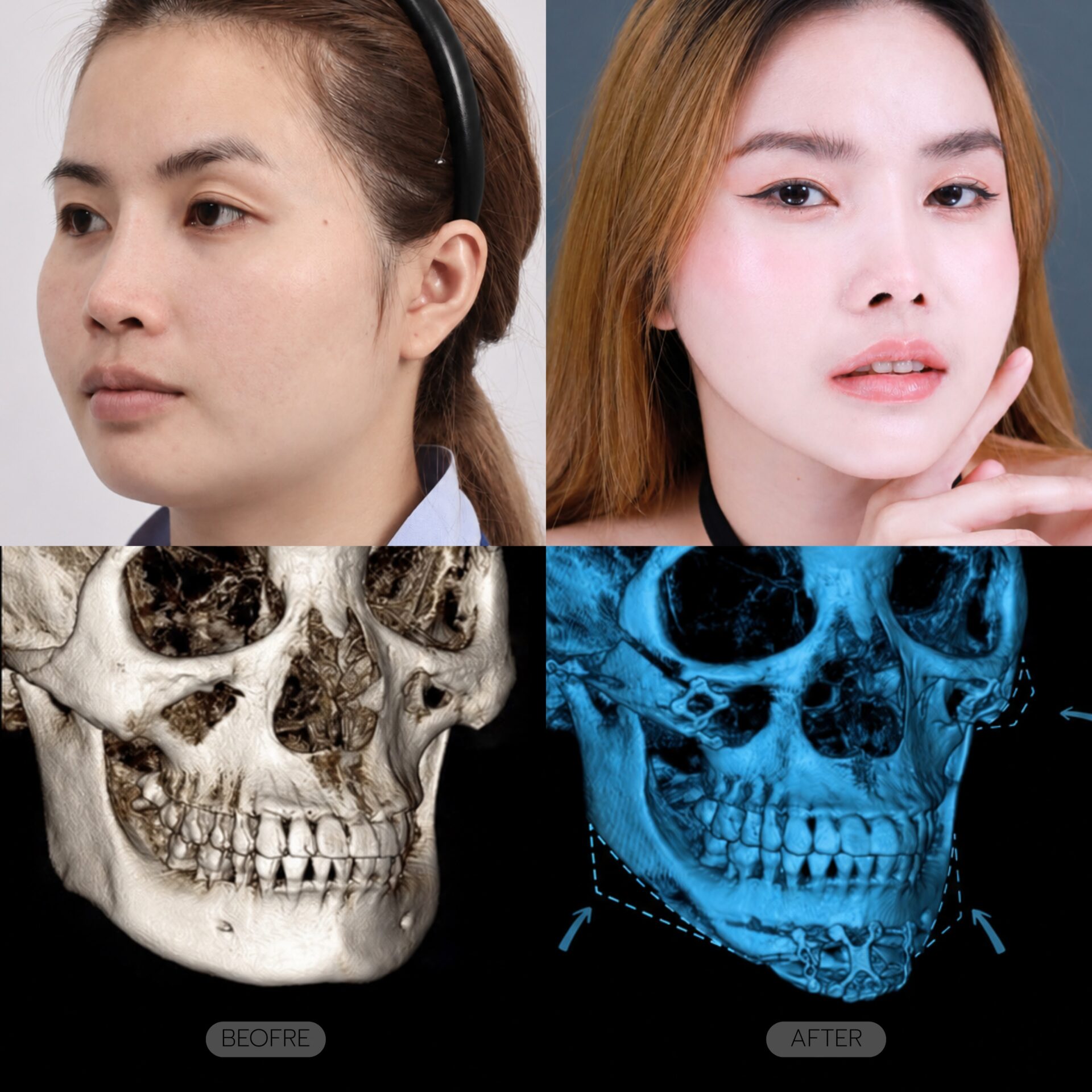 เลื่อนคาง