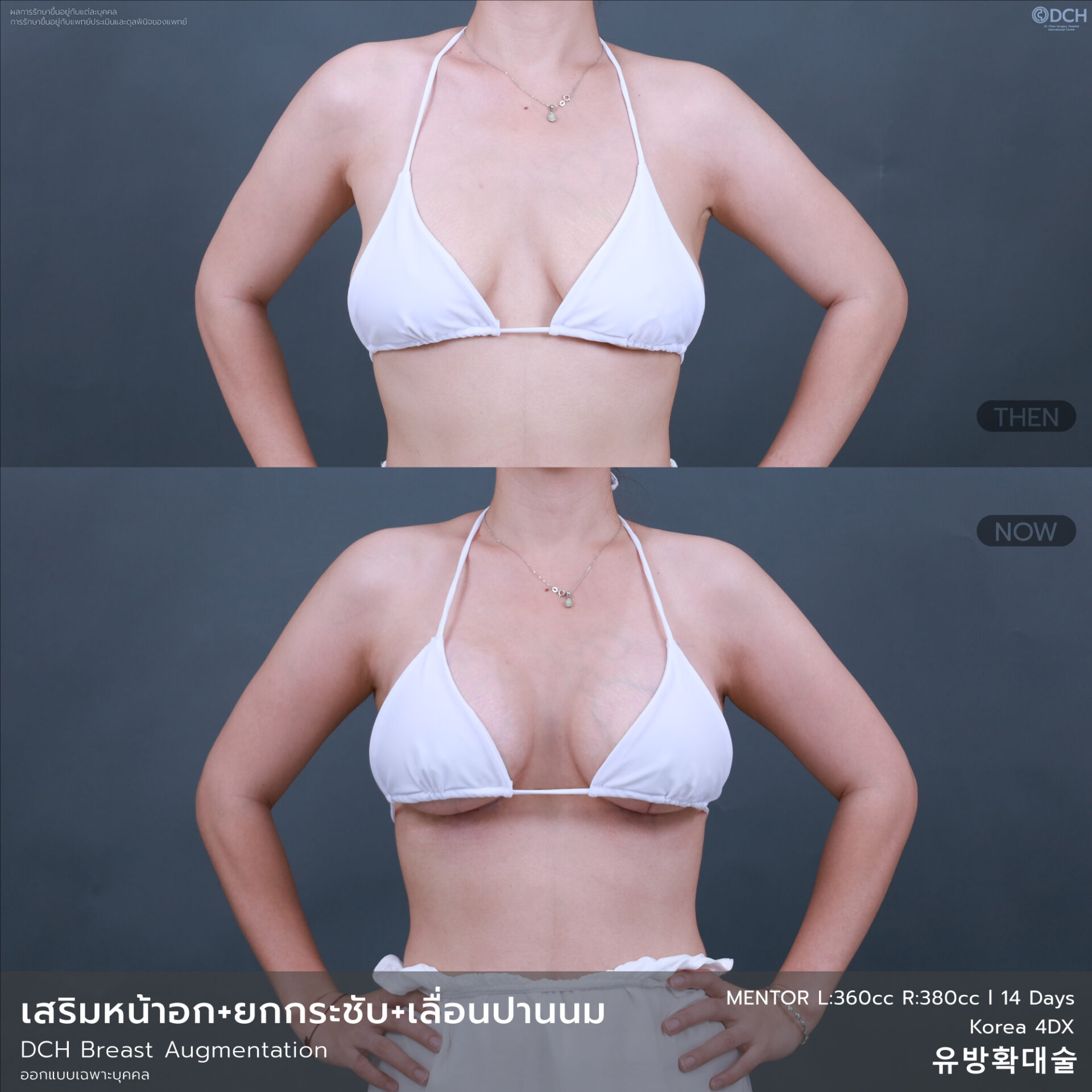 B-A-หน้าอก-คุณSwan-14วัน-01
