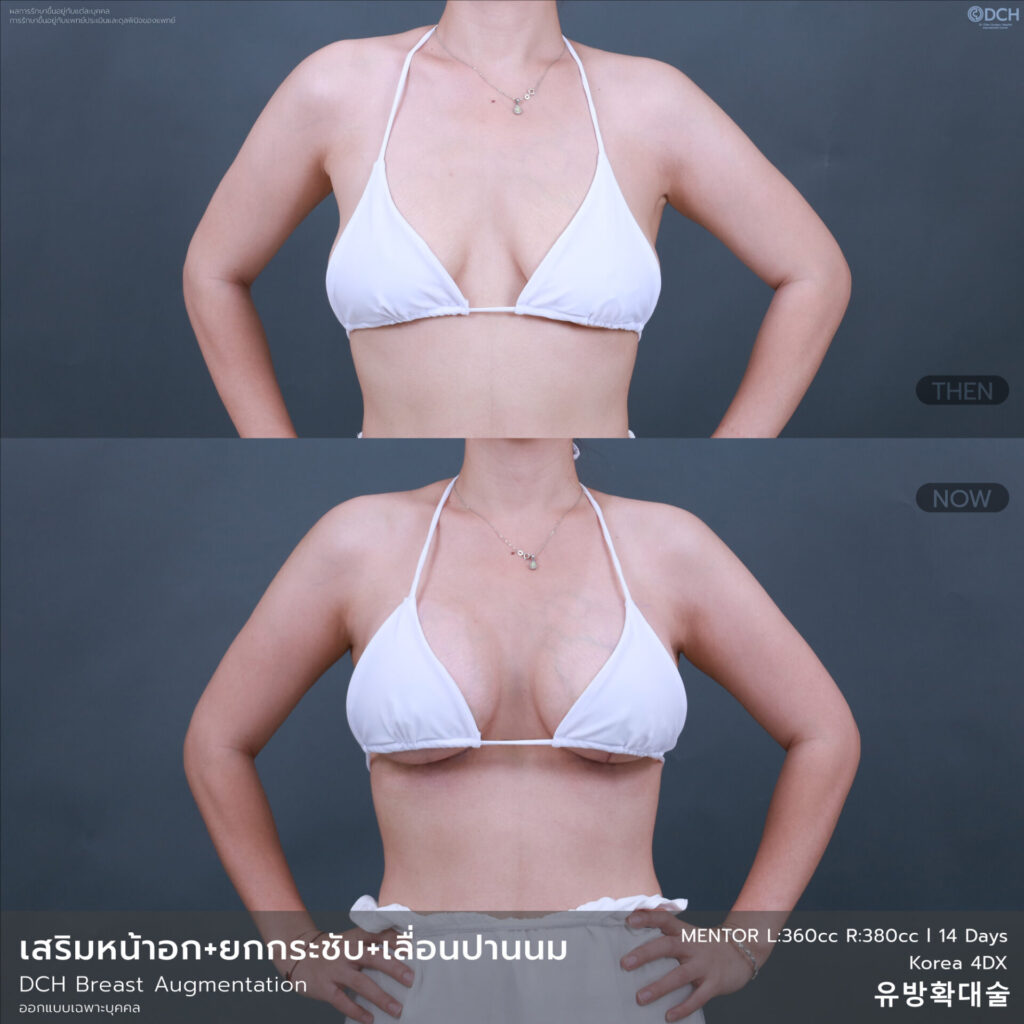 B-A-หน้าอก-คุณSwan-14วัน-01