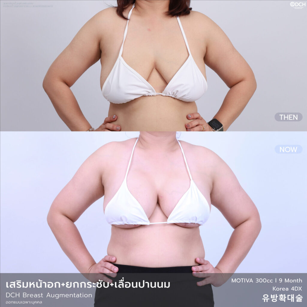 B-A-หน้าอก-คุณฝ้ายMentor 300 ยกกระชับตัวT + เลื่อนปานนม-9เดือน-01