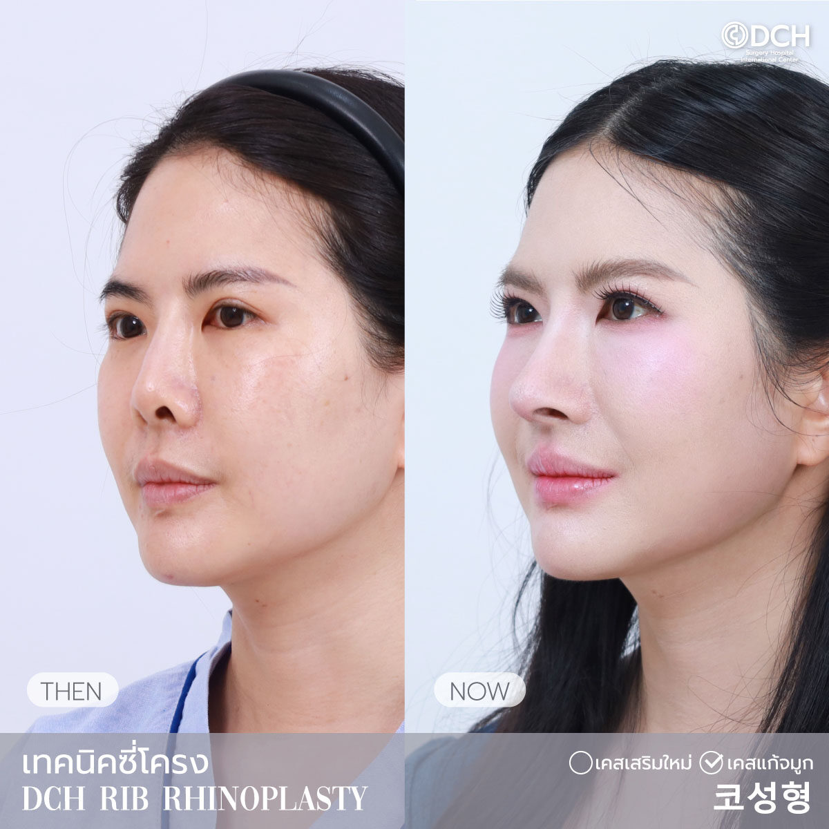 B-Aซี่โครง14