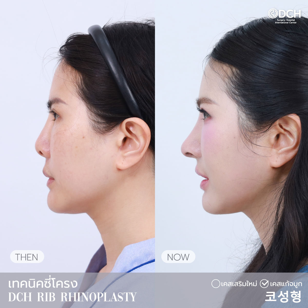 B-Aซี่โครง15