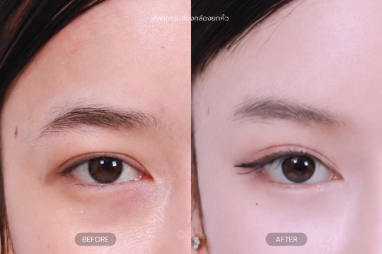ส่องกล้องยกคิ้ว
