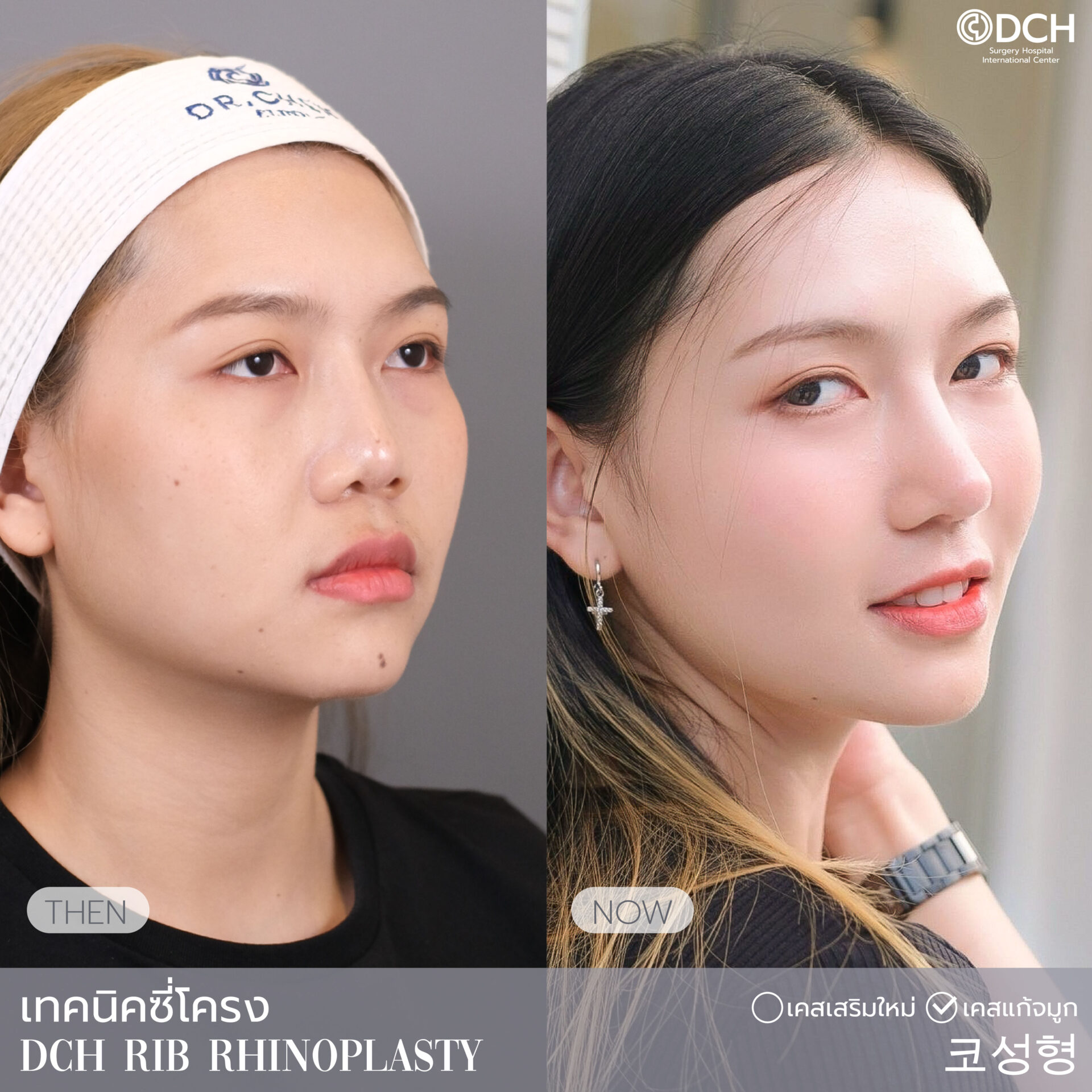 รวมรีวิวจมูกซี่โครง-6-25