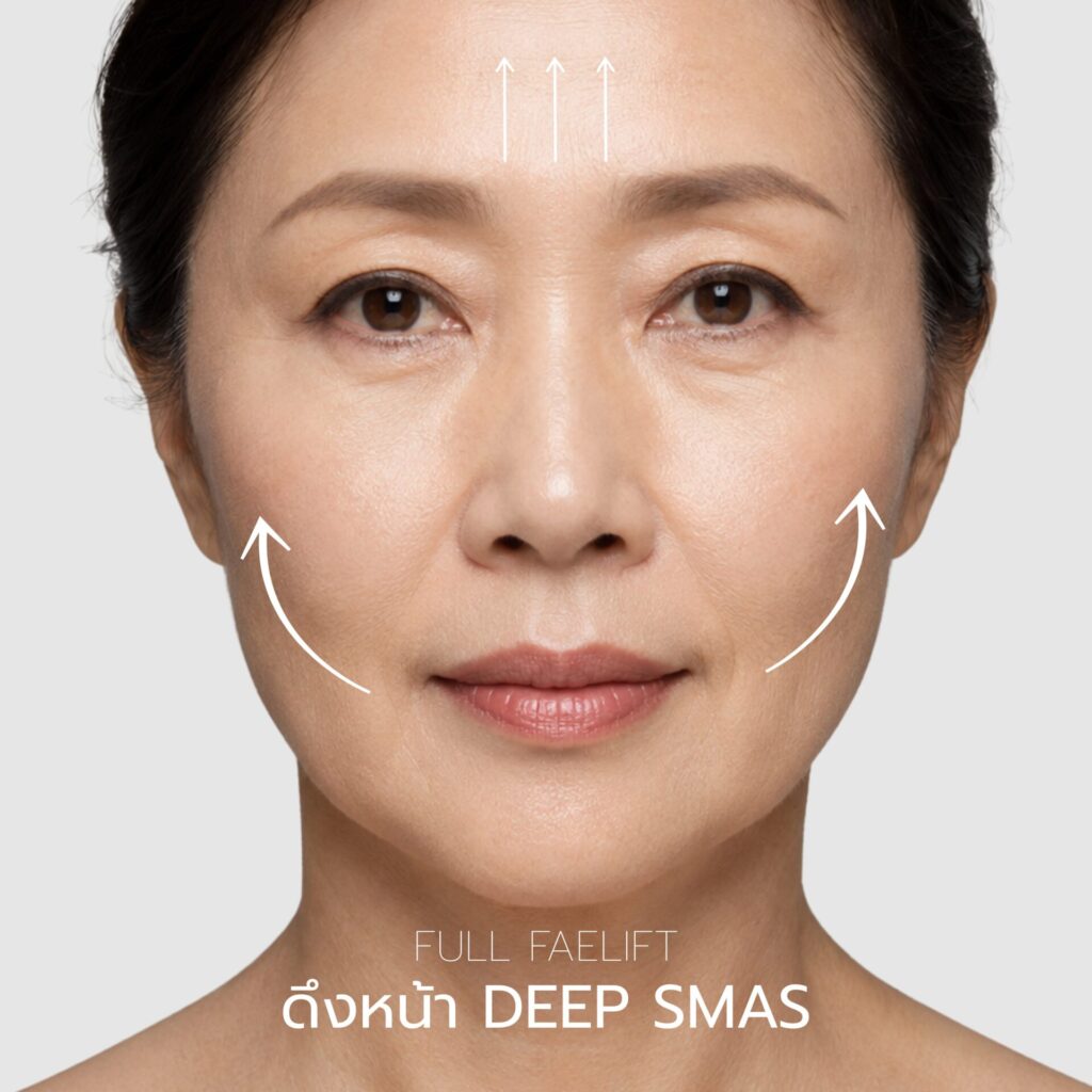 Full Facelift