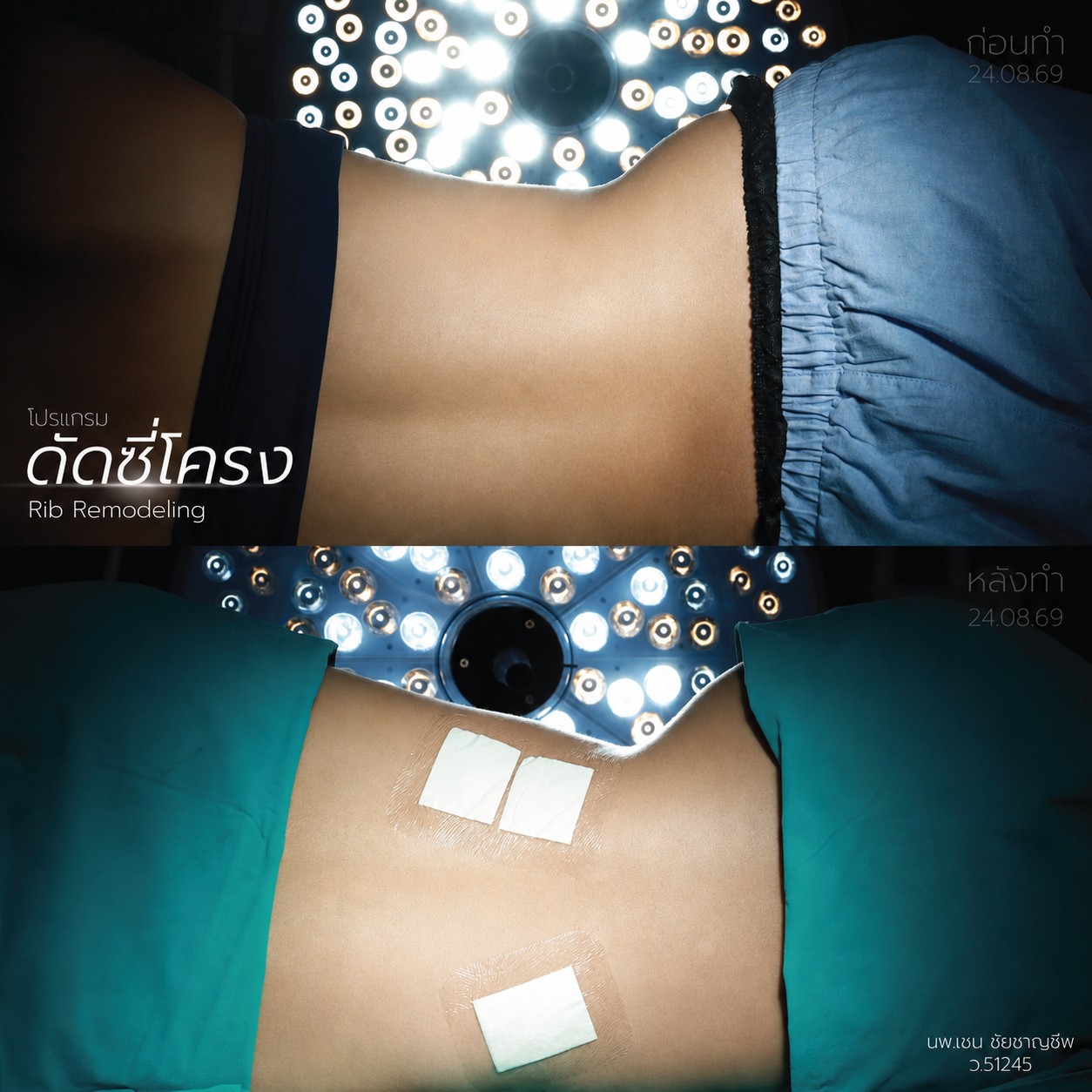 BA-ดัดซี่โครง-พะพาย -หลังทำทันที
