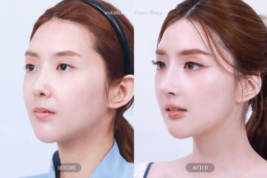 เสริมจมูกซี่โครง