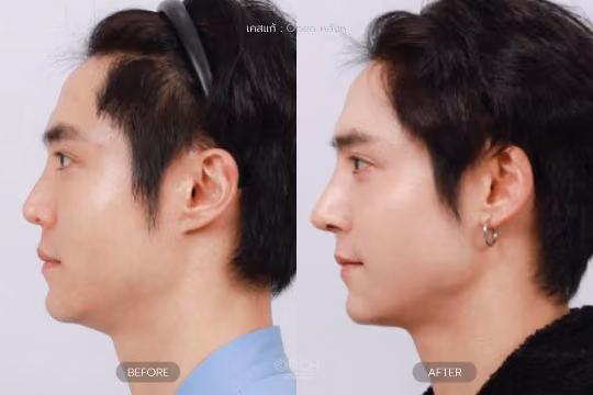 แก้จมูกหลังหู