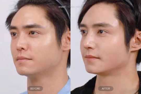 แก้จมูกหลังหู