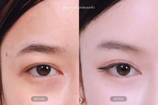 ส่องกล้องยกคิ้ว